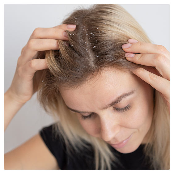Treating Dandruff